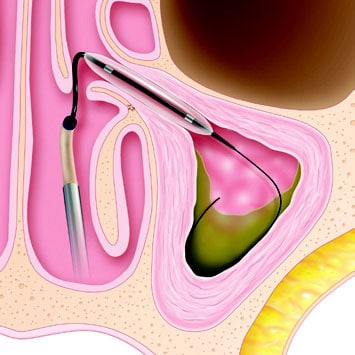 Balloon Sinuplasty Procedure Illustration of balloon sinuplasty device in sinus cavity